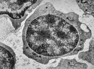 F,21y. | bone marrow - sideroblastic anemia